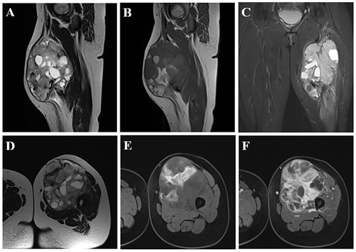 Figure 1 A 28-year-old female patient with synovial sarcoma in the left thigh. The tumor had a heterogeneous signal on sagittal T2W (A) and sagittal T1W (B) and included a cystic component that appeared hyperintense on T2W (A) and hypointense on T1W (B) and a hemorrhagic component that showed a hyperintense signal on T1W (B). Peritumoral edema manifested as hyperintensity on STIR (C). The tumor had a multilobulated margin, a relatively well-defined border with surrounding structures, and many septa inside (D). The necrotic part of the tumor comprised the hypointense portion on T1W images (E), without enhancement after injection (F). The tumor was in contact with the femoral bone but without cortical erosion, bone marrow edema, and involvement of the femoral great vessel on T1 C+ (F).