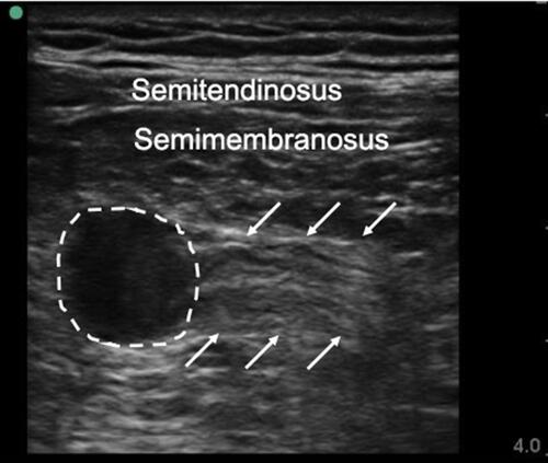 Figure 3 The ultrasonography of the long axis of the stump neuroma. The dash line indicated neuroma, and the arrow indicated nerve.