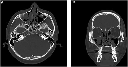 Figure 4. Images of sinus computed tomography. Soft tissue density lesions were filling maxillary and ethmoid sinuses on both sides. (A,B) show axial and coronal view, respectively.