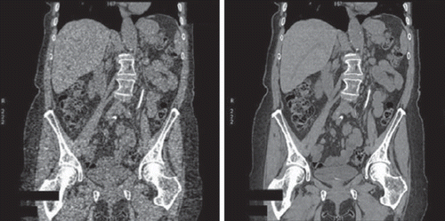 Figure 4. Coronal CT slice acquired at low dose, reconstructed with filtered back projection (left) and iterative statistical reconstruction (right) (image courtesy GE Healthcare).