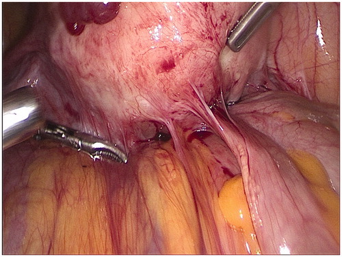 Figure 2. Pelvic adhesions detected under laparoscopical surgery.