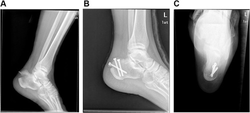 Figure 1 (A) Lateral X-ray of calcaneus, obvious displacement of calcaneal tuberosity. (B) Lateral X-ray of the calcaneus after the first operation, the fracture was fixed by three hollow lag screws. (C) Axial X-ray of the calcaneus after the first operation, and the screw can be fixed in position.