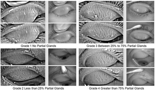 Figure 1 Meibograph grades based on meibomian gland dropout in upper eyelids only. Grade 1 represents no partial glands; Grade 2 represents less than 25% partial glands; Grade 3 represents 25% to 75% partial glands; and Grade 4 represents greater than 75% partial glands.