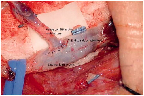 Figure 3. Micro vascular anastomosis.