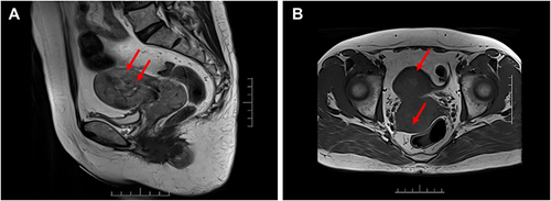 Figure 4 The location and TWI signal ((A): T2WI, (B) T1WI) of the tumor on MRI. The red arrows indicate the locations of the tumor.