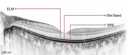 Figure 1 Normal Heidelberg spectral domain optical coherence tomography (SD-OCT) with intact external limiting membrane (ELM), photoreceptor inner segment ellipsoid band (ISel), and retinal pigment epithelium (RPE).