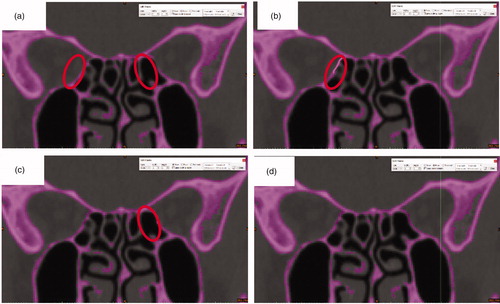 Figure 4. Repair the holes. a) The purple parts in the red circle should be connected. The CT scanning and thresholding value setting may cause some missing parts of the digital model. b) Using Menu bar > Segment > Edit Masks and selecting “Circle” with reasonable size and selecting “Draw” to connect the part on the left. c) Using the same steps as b) to repair the part on the right. d) the complete slice. Since the skull is stereoscopic, we have to “Draw” the missing parts slice by slice.