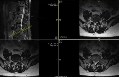 Figure 4 Postoperative MRI showed that the herniated disc disappeared and the spinal canal was enlarged.