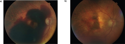Figure 3 Male aged 83 years (patient no. 3). Baseline fundus photograph (a) and 2 weeks after the surgery showing a tear of the retinal pigment epithelium (b).