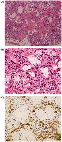 Figure 1. Typical pathological findings in LSGs sample in a representative patient with IgG4-RD. A 61-year-old female was diagnosed with IgG4-RD based on persistent bilateral lacrimal and submandibular glands swelling, high serum IgG4 level (971 mg/dL), and infiltration of typical IgG4+ plasmacytes and fibrosis of the left submandibular gland tissue obtained by needle biopsy. She also underwent LSGs biopsy. (A) Hematoxylin and eosin staining of LSGs (original magnification ×40). Note the lymphoplasmacytic infiltration and mild fibrosis, compared with relative conservation of the ducts and acinar cells. (B) Hematoxylin and eosin staining of LSGs (original magnification ×400). Note the lymphoplasmacytic infiltration around the conserved ducts and acinar cells. (C) Immunohistochemical staining for IgG4 in LSGs (original magnification ×400). Note the marked infiltration of IgG4+ plasmacytes.
