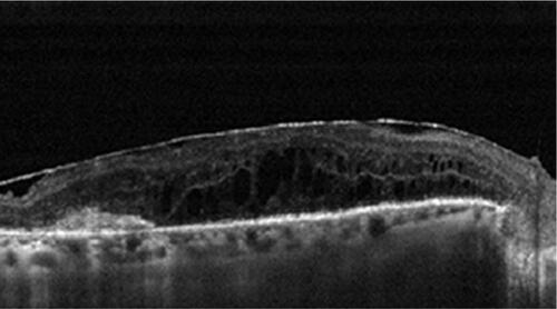 Figure S4 OCT image of an epiretinal membrane 180 days after intravitreal dexamethasone injection.Abbreviation: OCT, optical coherence tomography.