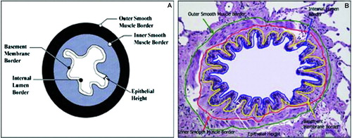 Figure 1.  A. Illustration of the small airway depicting quantitative measurements performed. B. Representative airway with borders and compartments measured are outlined with different colors. From reference 14 Reprinted with permission of the American Thoracic Society. Copyright © American Thoracic Society. Victor Kim, Gerard J. Criner, Heba Y. Abdallah, John P. Gaughan, Satoshi Furukawa, and Charalambos C. Solomides. Airway Morphometry and Improvement in Pulmonary Function after Lung Volume Reduction Surgery. AMERICAN JOURNAL OF RESPIRATORY AND CRITICAL CARE MEDICINE, Jan 2005; 171: 40–47. OFFICIAL JOURNAL OF THE AMERICAN THORACIC SOCIETY DIANE GERN, Publisher