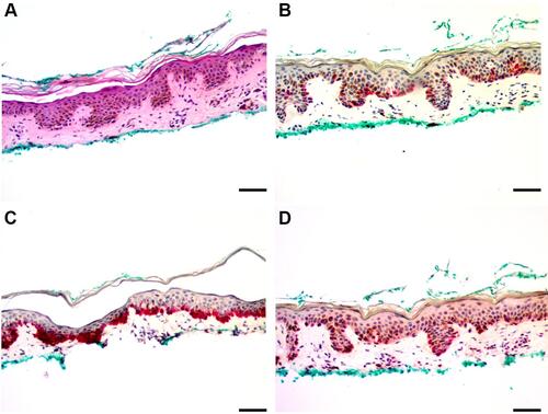 Figure 1 Mild atypical junctional proliferation. (A) H&E stain, (B) HMB-45 stain, (C) Melan-A stain, (D) SOX-10 stain. More intense staining noted for Melan-A and SOX-10 at the dermo-epidermal junction. Scale bar = 50 µm.