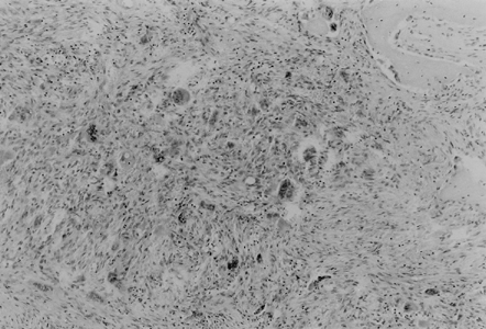 Figure 2. Diffuse sheets of chief cells without stromal and intracellular fat (HE).