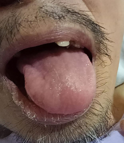 Figure 4 The disappearance of white plaque covering intraoral mucosa and the surface of the tongue patient.