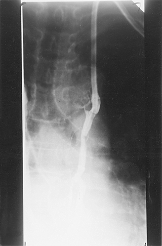 Figure 3. The injection of the contrast media via the catheter shows the internal thoracic vein.