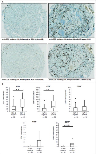 Figure 4. Immunohistochemical staining of tumor-infiltrating lymphocytes in RCC lesions (TMAs). (A) : Representative immunohistochemical staining of CD3+ and CD8+ TILs on a HLA-G− and HLA-G+ RCC lesion revealing statistical significant higher numbers of CD3+ and CD8+ T lymphocytes in HLA-G+ tumors. (B) Mean numbers of CD3+, CD8+, CD4+, CD56+ and CD69+ cells per field of view in 36 HLA-G− and 36 HLA-G+ RCC lesions (listed in Table 1) visualized as Box–Whiskers-Blots. Only CD3+ (p < 0,001) and CD8+ (p < 0,001) TILs showed significant differences in the presence in the HLA-G+ and HLA-G− cohorts.