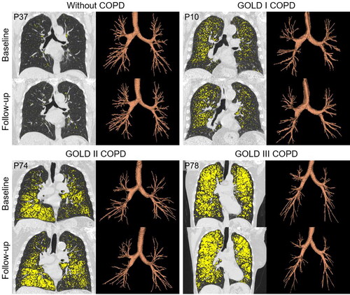 Figure 3. Baseline and three-year follow-up CT imaging for representative ex-smokers with and without COPD. P37 is a 70-year-old female ex-smoker without COPD, with follow-up time = 31 months (baseline/follow-up: FEV1%pred = 93%/93%; RA950 = 1%/1%; TAC = 306/297). P10 is a 75-year-old male ex-smoker with GOLD I COPD, with follow-up time = 33 months (baseline/follow-up: FEV1%pred = 92%/84%; RA950 = 7%/8%; TAC = 265/231). P74 is an 83-year-old male ex-smoker with GOLD II COPD, with follow-up time = 28 months (baseline/follow-up: FEV1%pred = 57%/52%; RA950 = 20%/23%; TAC = 258/191). P78 is a 67-year-old female ex-smoker with GOLD III COPD, with follow-up time = 26 months (baseline/follow-up: FEV1%pred = 37%/33%; RA950 = 33%/37%; TAC = 206/174). Left: Coronal CT reconstruction with RA950 shown in yellow. Right: Three-dimensional reconstruction of the segmented airway tree.