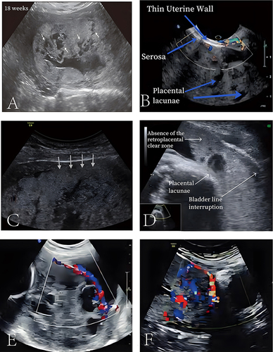 Figure 3 Ultrasonic images of placenta accreta spectrum. (A) White arrows represent different sizes of placental lacunae at 18 weeks of pregnancy. (B) Blue arrows represent large placental lacunae images with placenta invading the uterine serosa. (C) White arrows represent partial loss of the retroplacental hypoechoic clear zone. (D) White arrows represent complete loss of the retroplacental clear zone accompanied by large placental lacunae and uterine-bladder boundary line thinning and irregularity. (E and F) Increased placental blood flow on 2D ultrasound. Red color represents increased placental blood flow moving to the transducer; Blue color represents placental blood flow leaving away from the transducer.