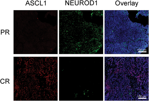 Figure 6. Molecular subtype identification of two SCCE cases using mIHC staining with ASCL1 and NeuroD1 antibodies. Scale bar: 100 μm.