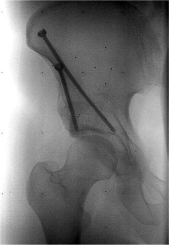 Figure 18. Radiograph with bone markers. The position of the markers affect the estimation of migration. The markers should not be positioned closely.