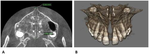 Figure 11 Patient CBCT after expansion, before the start of maxillary protraction. (A) Axial palatal section. (B) Maxilla 3D rendering.