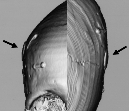 Figure 3 Three-dimensional computed tomography showing a burr hole placed snugly within the burr hole at the linea temporalis.