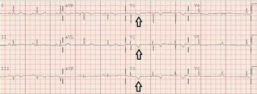Figure 1. Resting 12-lead EKG showing symmetric T wave inversion in right precordial leads (V1, V2 and V3) (see black arrows).