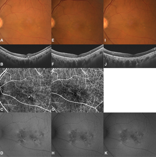 Figure 1 A 75-year-old man with previously untreated polypoidal choroidal vasculopathy (PCV). Best-corrected visual acuity (BCVA) of the right eye was 0.52 logMAR units at baseline. (A–D) Images were obtained at the baseline. (A) A colour fundus photograph showed elevated Orange-red lesion and retinal pigment epithelium (RPE) degeneration at the macula. (B) Optical coherence tomography (OCT) B-scan through the fovea showed a protruding pigment epithelial detachment (PED) and double layer sign due to polypoidal lesions with serous retinal detachment (SRD). The CMT and CCT were 242 µm and 546 µm respectively. (C) Indocyanine green angiographic (ICGA) image detected branching neovascular networks with two polypoidal lesions. (D) Fundus autofluorescence (FAF) revealed a mix of hyperautofluorescence and hypoautofluorescence which corresponded to RPE degeneration. (E–H) Images were obtained at 3 months after photodynamic therapy combined with intravitreal aflibercept. BCVA of the right eye was 0.52 logMAR units. (E) A colour fundus photograph showed diminished Orange-red lesions. (F) OCT B-scan through the fovea detected no SRD and polyps regressed. The CMT and CCT were 158 µm and 533 µm respectively. (G) ICGA identified no polypoidal lesions but the branching neovascular network remained. (H) FAF showed a mix of hyperautofluorescence and hypoautofluorescence and RPE atrophy gradually expanded. (I–K) Images were obtained 2 years after the initial treatment. BCVA of the right eye was 0.30 logMAR units. (I) A colour fundus photograph showed RPE degeneration. (J) OCT B-scan through the fovea showed small PEDs but no SRD. The CMT and CCT were 176 µm and 497 µm, respectively. (K) FAF revealed enlarged RPE atrophy in the area where polyps had developed.