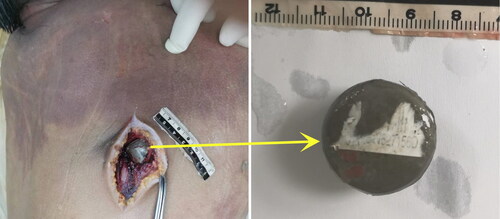 Figure 4. Cylindrical metal extracted from the right back (metal a).