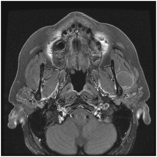 Figure 1. Axial T1-WI with fat saturation showing a well-circumscribed hypointense lesion located in the posterior part of the left masseter muscle, anterior to the parotid gland, with thin rim enhancement after contrast injection.