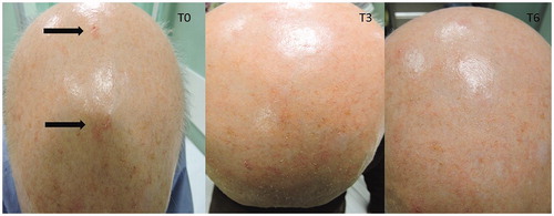 Figure 2. Visible improvement of AKs in OTRs patient during the study.