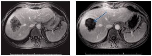 Figure 1. MRI scans demonstrating secondary colorectal carcinoma within the right lobe of the liver. Left: An MRI scan of a patient before HIFU treatment. Right: An MRI scan after HIFU treatment showing lack of contrast uptake (arrow).