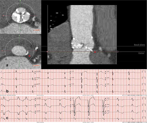 Figure 3. Implications of aortic valve calcification and conduction abnormalities after transcatheter aortic valve implantation