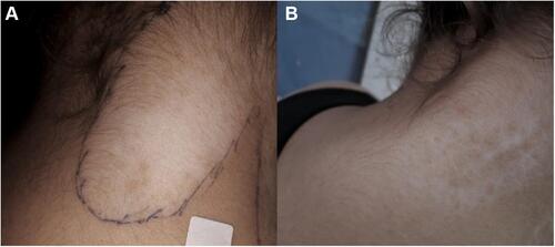 Figure 2 Vitiligo vulgaris lesion on nape of the neck treated by mini-punch grafts. (A) Baseline surface area of 7.3 cm2. (B): 47.9% Repigmentation after 6 months.