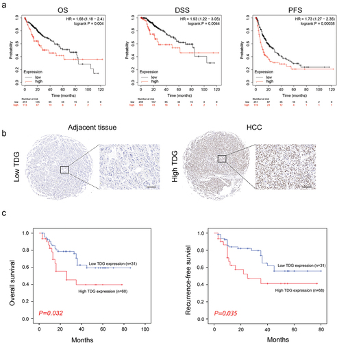 Figure 2. The relationship between TDG expression and prognosis in HCC. (a) Association between TDG and OS, DSS and PFS of HCC patients. (b) Immunohistochemical analysis of TDG expression in HCC. (c) Kaplan–Meier analysis of overall survival and recurrence-free survival between in HCC patients with high and low TDG expression. Scale bars, 100 mm.