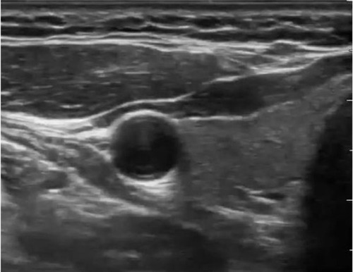 Figure 1 Sonographic view of drug distribution in the SGB.Abbreviation: SGB, stellate ganglion block.