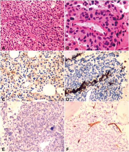 Figure 5 Morphologic and immunohistochemical features of the case. Marrow biopsy showed the architecture was diffusely infiltration by clusters of oval and short spindle cells ((A and B), 200× and 400×). The neoplastic cells were positive for CD117 (C), but almost all negative for MPO (D), CD25 (E), and CD34 (F), 200×.