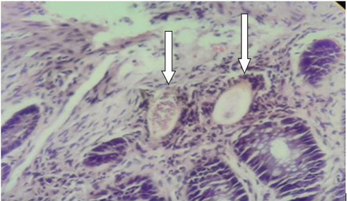 Figure 3 High power photomicrograph showing eggs of S.mansoni (down arrows) with surrounding inflammatory cells.