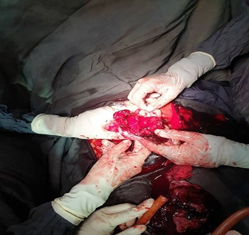 Figure 2 Shows left coronal fundal rupture.