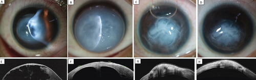 Figure 2. (a-c)- a: Slit-lamp photograph of the right eye when patient presented with a three-day history of acute hydrops; b: Slit-lamp photograph of the right eye after one month of conservative management showed marked increase in corneal edema; c: Slit-lamp photograph at first postoperative day showing rapid clearing of the peripheral cornea; d: Clinical picture on the fifth postoperative day showing further clearing of peripheral cornea. The optical coherence tomography pictures at first visit, one month after conservative treatment, postoperative day 1 and day 5 are depicted in e, f, g, and h, respectively.