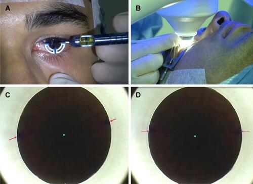 Figure S1 (A) Preoperative limbal marking with Ganesh bubble marker under topical anesthesia in upright position. This instrument gives 3 marks on the limbus at 0°, 90°, and 180°, extending 2 mm toward the center of the cornea which are easy to visualize while the eye is being docked. (B) Method of manual cyclotorsion compensation by a gentle rotation of the cone while holding the same at the attachment of the tube to the cone. (C) Position of the limbal marks (red arrows) under suction “on” condition without cyclotorsion compensation before starting the laser, showing approximately 12° of cyclotorsion. (D) Final position of the limbal marks after manual compensation of the cyclotorsion error (alignment with the horizontal axis of the eye piece reticule). Delivery of the laser follows this.