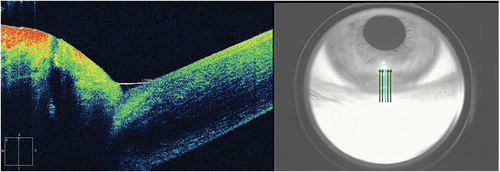 Figure 1. The image of lower tear meniscus height by Zeiss Cirrus HD optical coherence tomography 5000.