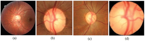 Figure 3. Pre-processing of fundus image with glaucoma (a) entire image (b) fundus image cropped around OD (c) fundus glaucoma image cropped around ONH including RNFL region (d) segmented optic disc region.