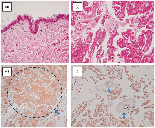 Figure 3. (a,b) The subcutaneous tissue was degenerated broadly (Haematoxylin and eosin staining). (c) Extensive amyloid deposition in the subcutaneous tissue (arrow) (Congo red staining). (d) No evidence of vascular involvement (arrow: subcutaneous artery without amyloid deposition) (Congo red staining).