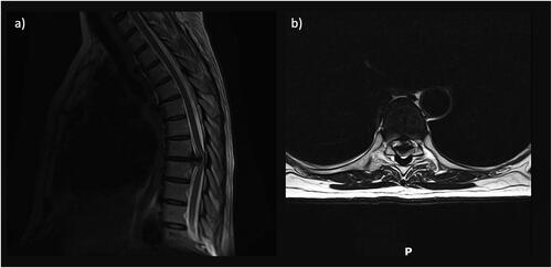 Figure 2. Case of degenerative thoracic disease, with pre-operative MRI scans displaying the large calcified T7-T8 disc prolapse in sagittal (a) and axial (b) profiles.