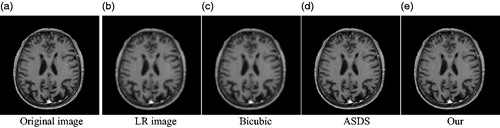 Figure 4. Comparison of the reconstructed images of various methods for noiseless medical image (Equation2(2) α=argminα∥α∥0,s.t.∥x−Φα∥2≤ε(2) ) (a) Original image (b) LR image (c) Bicubic (d) ASDS (e) Our.