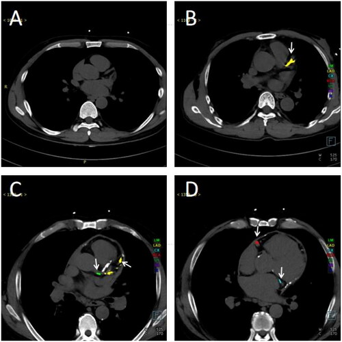 Figure 3. Cross-sectional CT images of ESKD patients with varying degrees of CACS. (A) An ESKD patient without coronary calcification. (B) An ESKD patient with calcification only in the LAD. (C–D) An ESKD patient with calcification in all four coronary branches. (C) Calcification in the left main trunk and left anterior descending branch. (D) Calcification in the circumflex branch and right coronary artery. Different colors represent each coronary branch with calcification (green: left main trunk; yellow: left anterior descending branch; blue: circumflex branch; red: right coronary artery), and the arrows indicated the calcified branches. Abbreviations: CT: computed tomography; ESKD: end-stage kidney disease; LAD: left anterior descending branch.