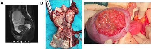 Figure 2 Ovarian involvement associated with the cervical adenocarcinomatous lesion. (A) Computed tomography depicting the pelvic lesion with a solid-cystic appearance. (B) The cervix and right ovary during surgery.