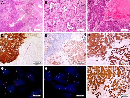 Figure 2 At low power, the neuroendocrine carcinoma (right) and adenocarcinoma component (left) were clearly separated (A, H&E ×20). At high-power magnification, necrosis and mitotic figures were frequently seen in adenocarcinoma (B) and neuroendocrine carcinoma (C, H&E ×400). Synaptophysin was positive only in the NEC component (D, IHC ×40). NapsinA was only positive in the adenocarcinoma area (E, IHC ×40). Both components showed immunoreactivity to CK7 (F, IHC ×40). FISH for ALK gene revealed that split signals and isolated 3′ signals were observed in adenocarcinoma and neuroendocrine carcinoma components, respectively (G and H). ALK rearrangement was also confirmed by ALK (D5F3) immunostaining (I, IHC ×40).